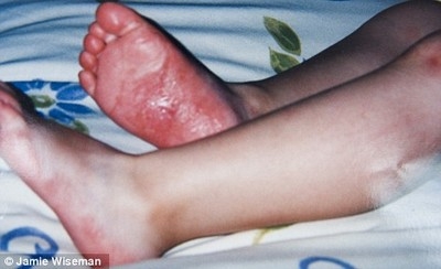 Cô bé đau đớn khi chạm vào mọi thứ