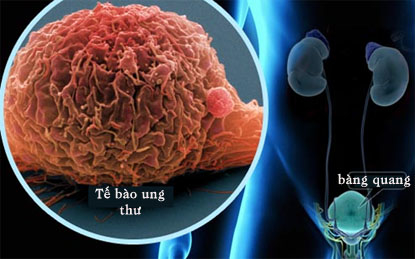 Tại sao không phải ai cũng bị bệnh ung thư?