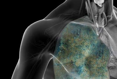 Thuốc lá gây ra bệnh gì?