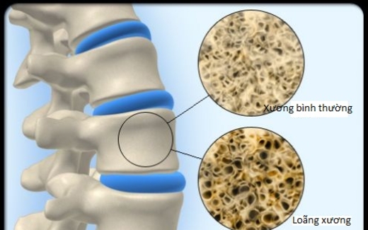 Kiểm tra bệnh loãng xương bằng tia X-quang kép (DXA)