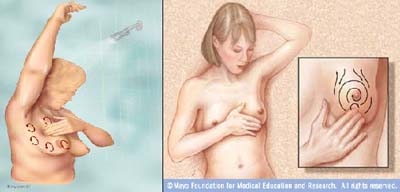 10 cách giúp giảm nguy cơ ung thư vú