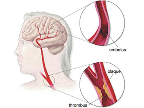 Nhũn não: nhân quả và bù trừ