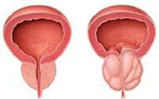 U xơ tuyến tiền liệt - biến chứng khôn lường