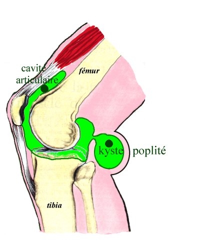 Thoái hóa khớp ở người lớn tuổi