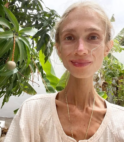 "Ăn thuần chay cực đoan" và cái kết đáng suy nghẫm