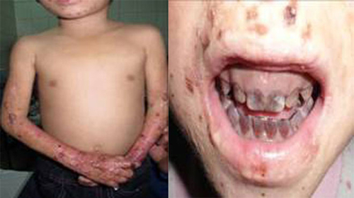 Bệnh “lạ” không chỉ ở Quảng Ngãi