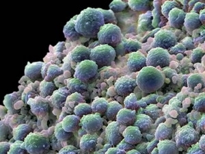 Lợi và hại khi phát hiện sớm ung thư tuyến tiền liệt