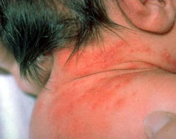 10 loại bệnh về da thường gặp