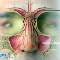 Rối loạn tiền đình cần điều trị triệt để