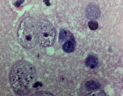 Bệnh nhi amip ăn não 'có thể bị nhiễm từ không khí'