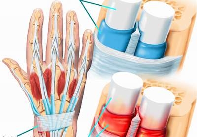 Đau cổ tay và hội chứng De Quervain