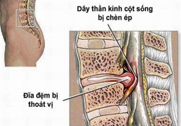Bệnh thoái hóa khớp ở người cao tuổi