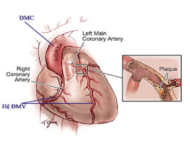“Mồi ngon” của bệnh lý mạch vành