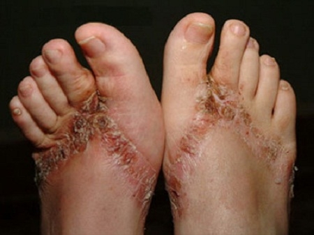 Nghi vấn có hóa chất độc hại từ dép trung quốc