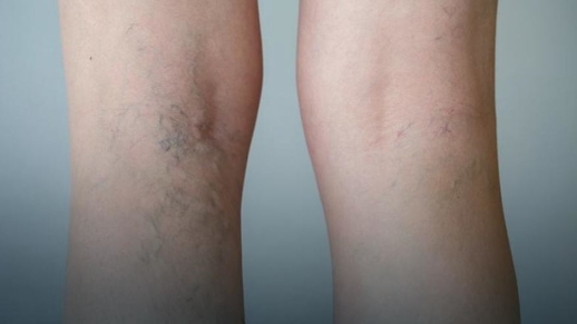 Máu đóng cục (huyết khối tĩnh mạch, Trombofilia) – kẻ giết người âm thầm và tấn công bất ngờ