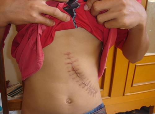 Qua TQ bán thận, có thể bị cắt trộm nội tạng