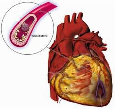 Bệnh nhồi máu cơ tim cấp