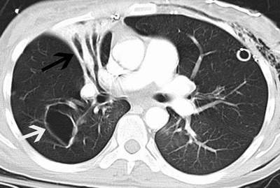 Ai dễ mắc bệnh giãn phế quản?