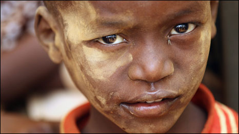 Liên Hiệp Quốc tuyên bố nạn đói ở nam Somalia